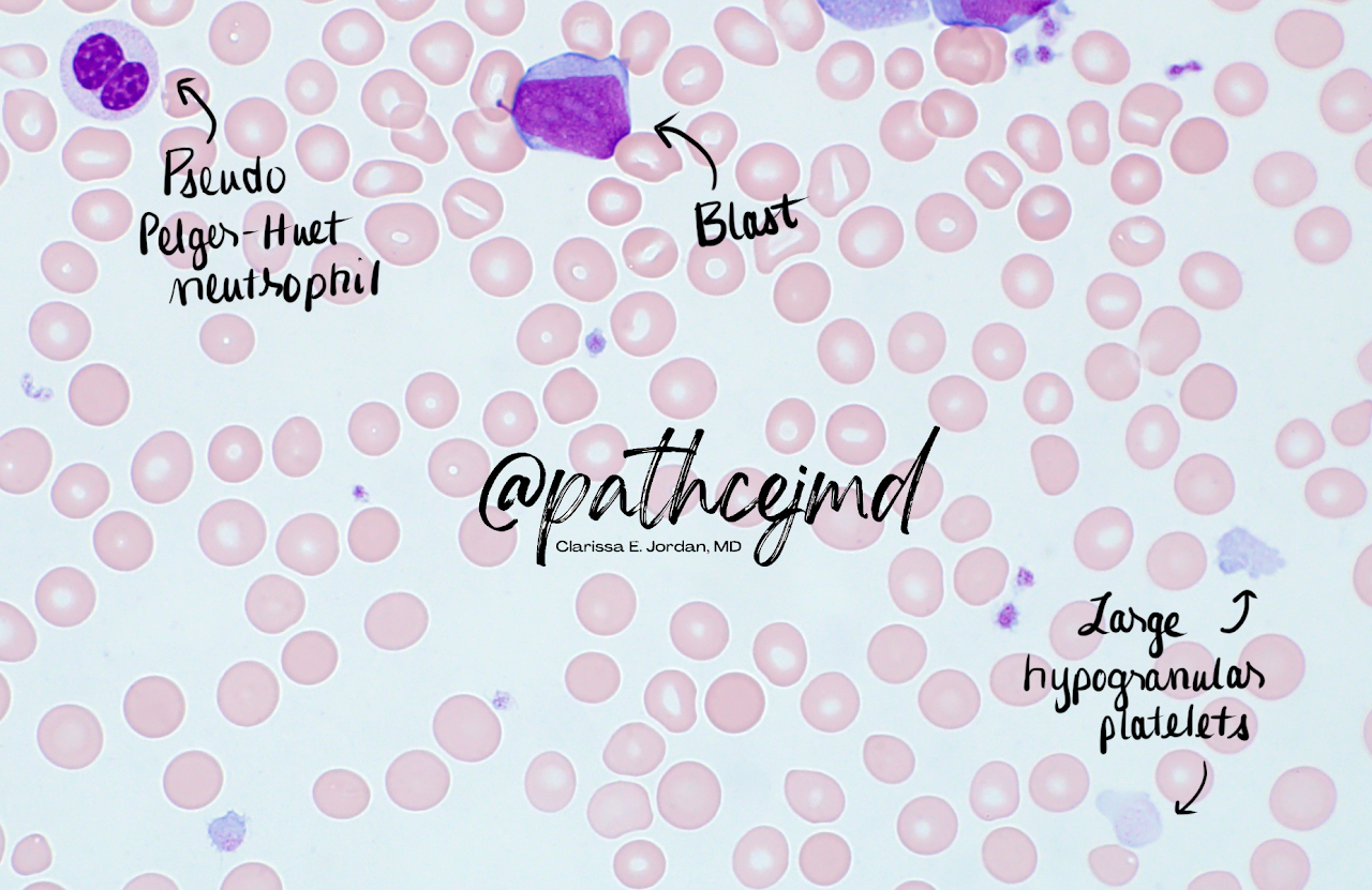 Case 10: AML Subtypes Compare and Contrast