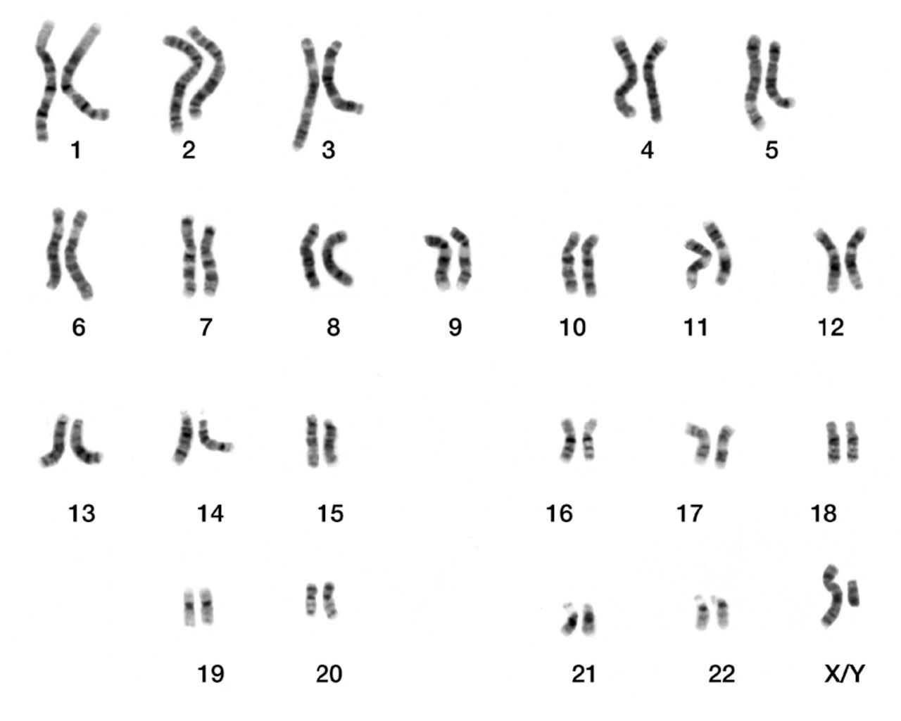 Case 6: AML with Inversion 16