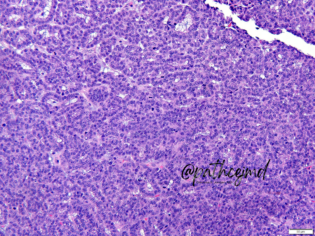 Case 9: Acinic Cell Carcinoma