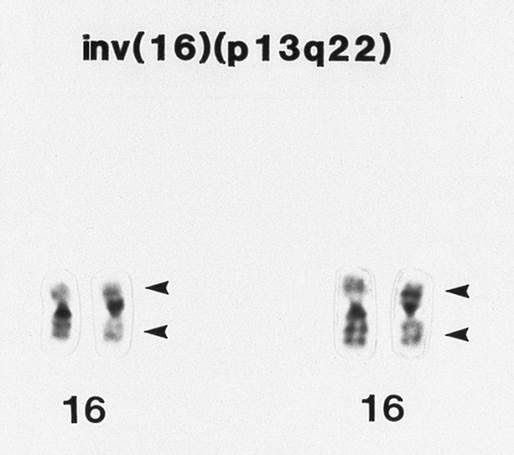 Case 6: AML with Inversion 16