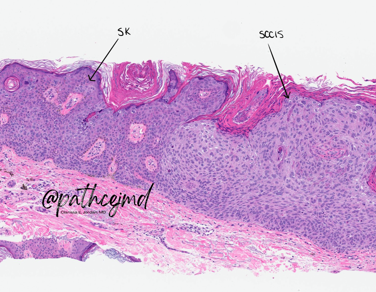 squamous cell carcinoma in situ histology