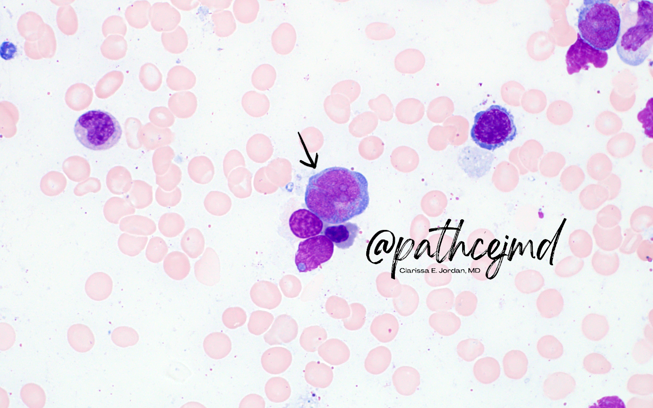 Case 4: AML with t(8;21)