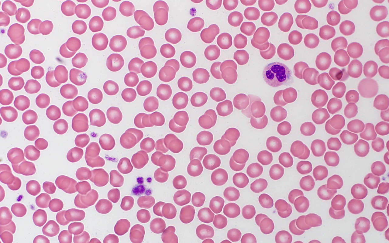 Case 2: MYH9-related Disorder