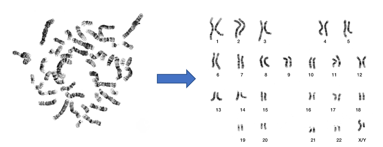 Case 6: AML with Inversion 16