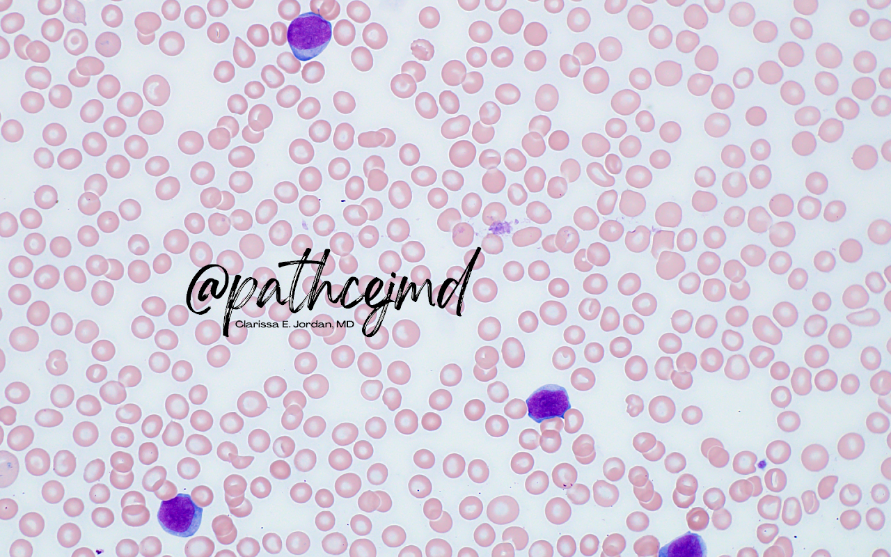Case 8: AML with t(1;22)