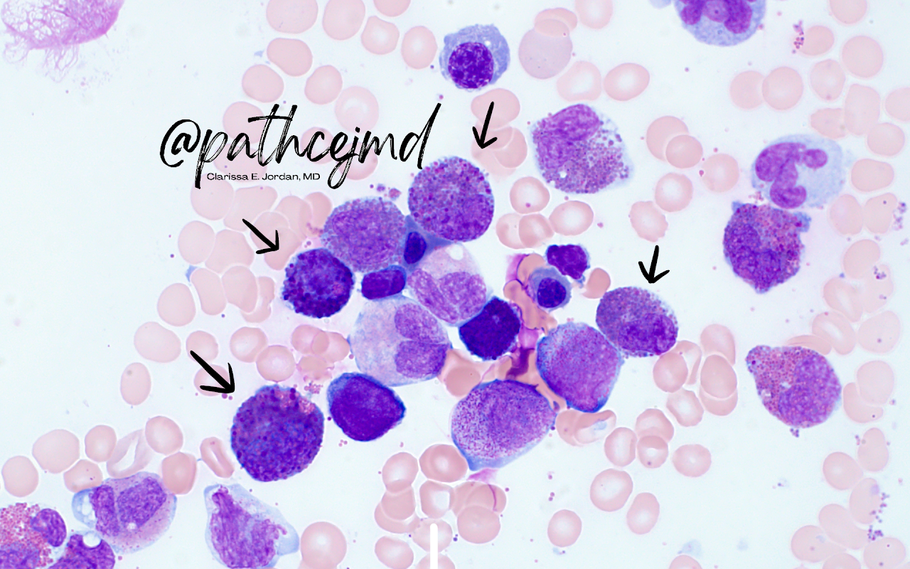 Case 6: AML with Inversion 16