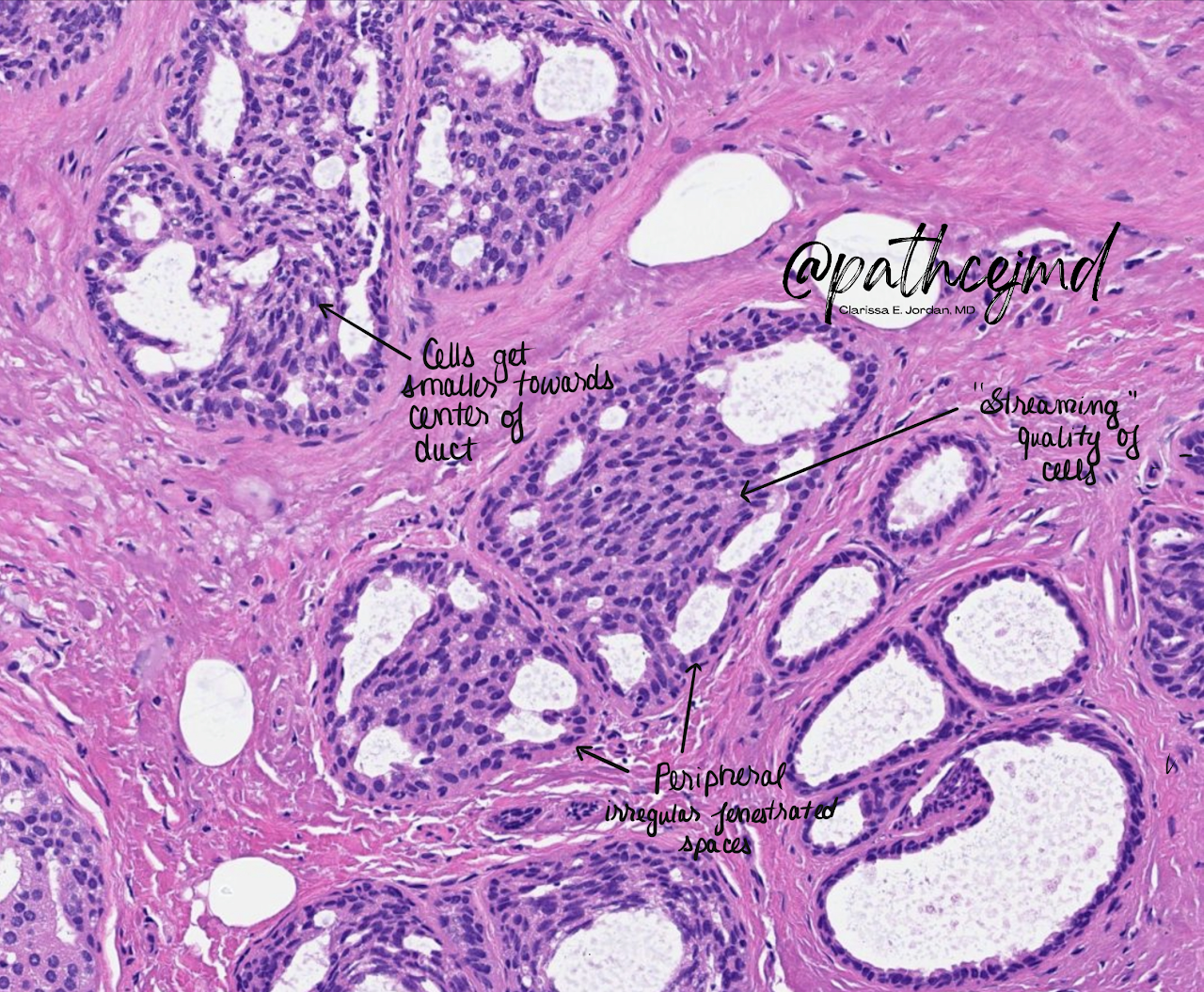 Case 16: UDH