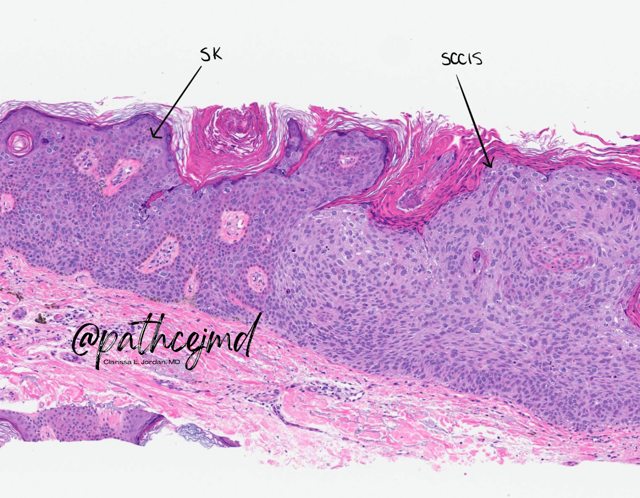 Case 15: Squamous Cell Carcinoma in Situ and Seborrheic Keratosis
