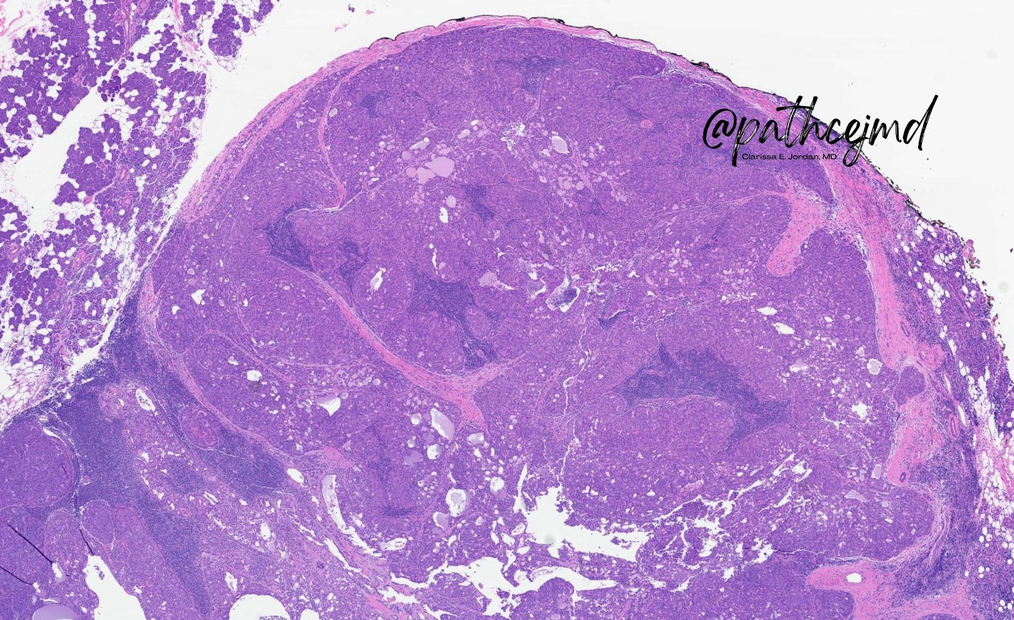 Case 9: Acinic Cell Carcinoma