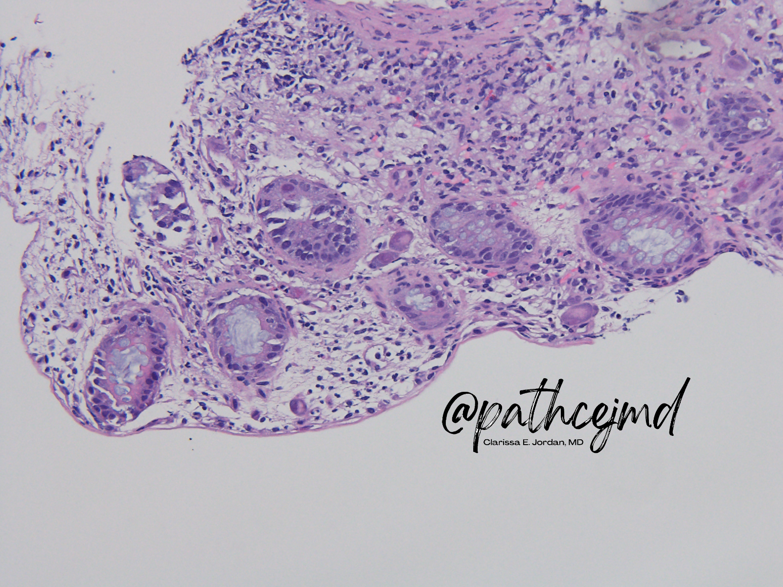 Case 7: CMV Colitis