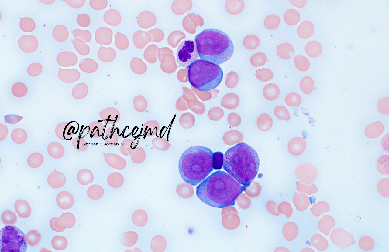 Case 12: AML with t(6;9)