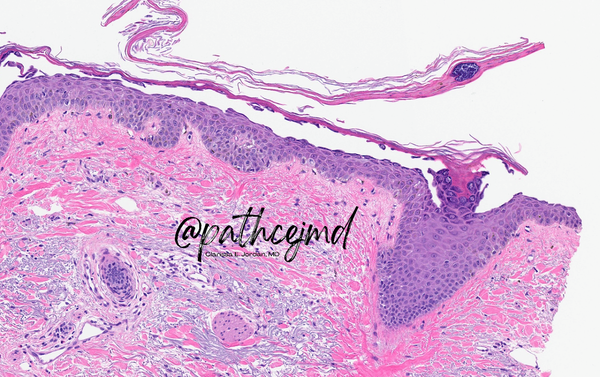 Case 14: Pemphigus Foliaceus