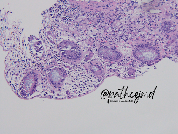 Case 7: CMV Colitis