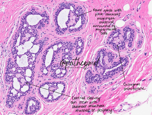 Case 17: Collagenous Spherulosis